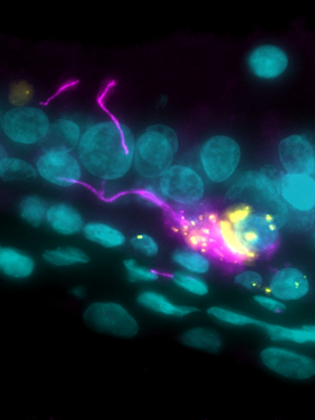 Durch sogenannte Immunfluoreszenz-Färbung sichtbar gemacht: eine mit <a href="https://www.charite.de/service/glossar/begriff/sars_cov_2/">Sars-CoV-2</a> (gelb) infizierte Nervenzelle (pink) in der Riechschleimhaut. 