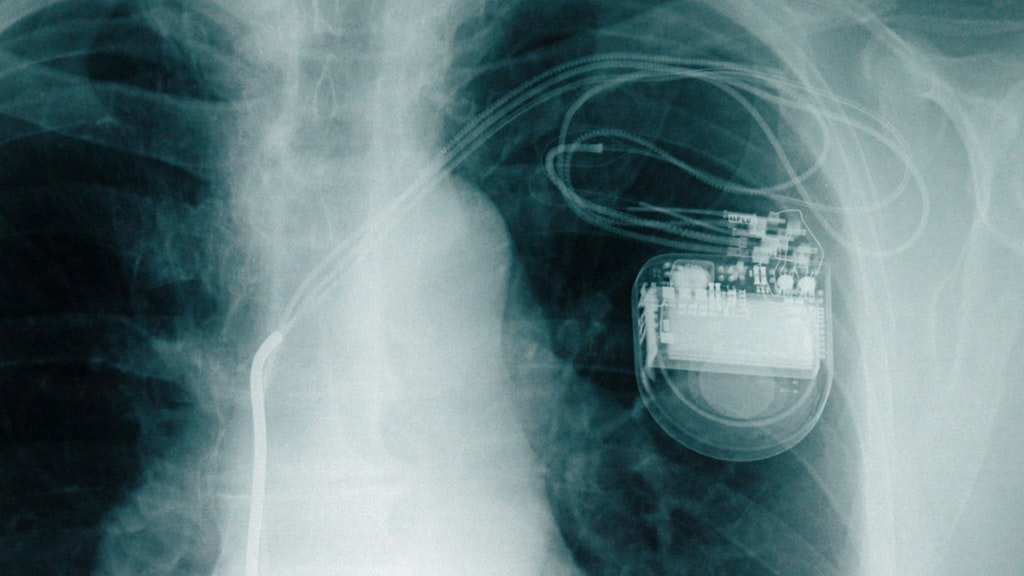 Lebensretter unter der Haut: Pro Jahr werden nach Angaben der Deutschen Gesellschaft für Kardiologie knapp 80.000 Herzschrittmacher implantiert.