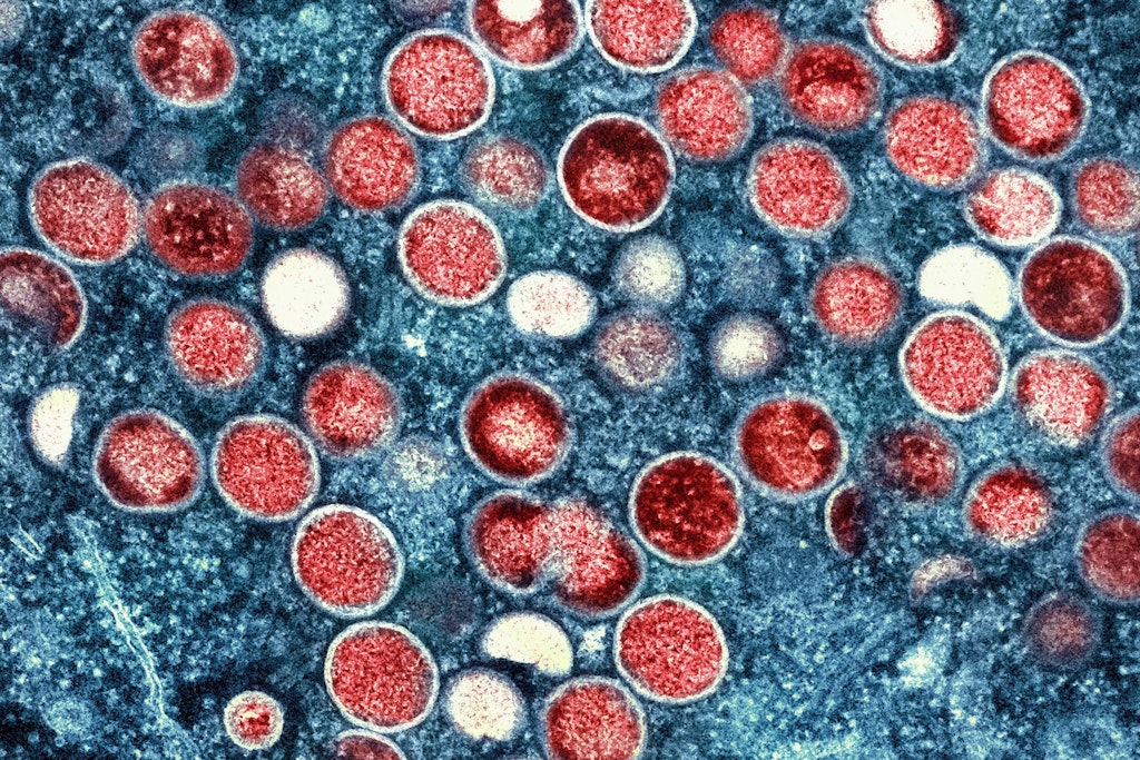 Berlin: Schon jetzt mehr Mpox-Fälle als im gesamten Vorjahr 2024