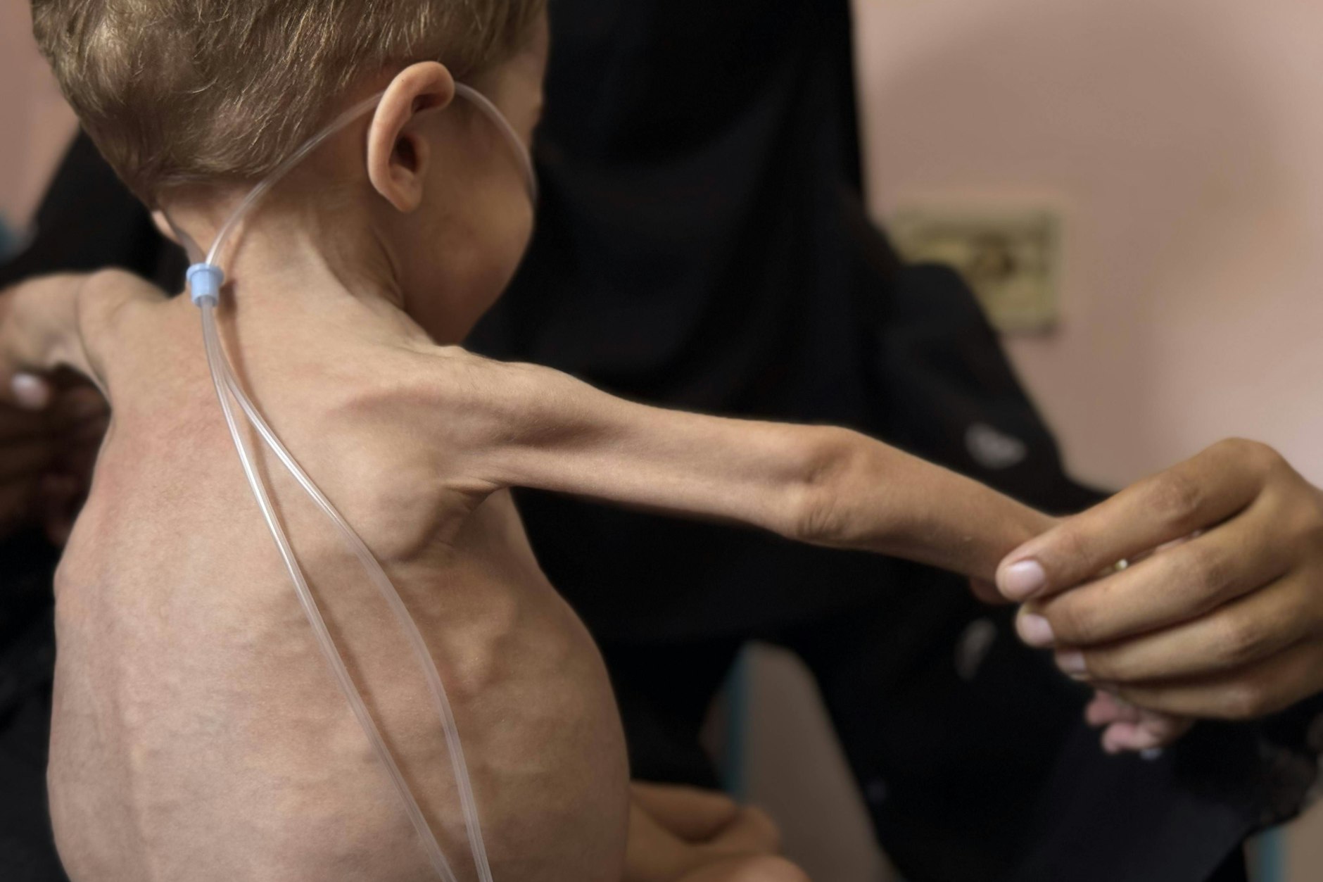 Ein dreijähriger Junge, der an schwerer Unterernährung, Lebervergrößerung, Knochenerweichung, Niereninsuffizienz und schweren Brustinfektionen leidet, wird im Nasser-Krankenhaus in Chan Yunis behandelt.