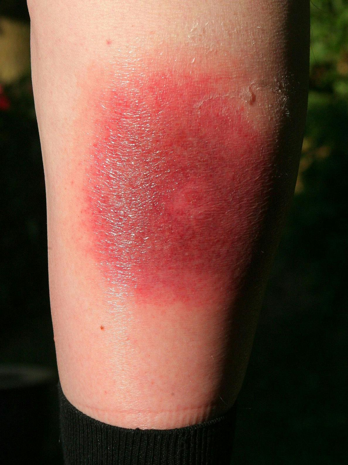 Sinal de alerta claro da doença de Lyme: o chamado eritema migratório pode aparecer dias ou semanas após uma picada de carrapato.