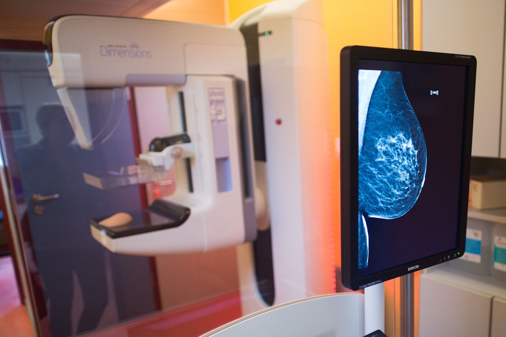 Brustkrebs: Charité stellt vielversprechende Therapieansätze vor